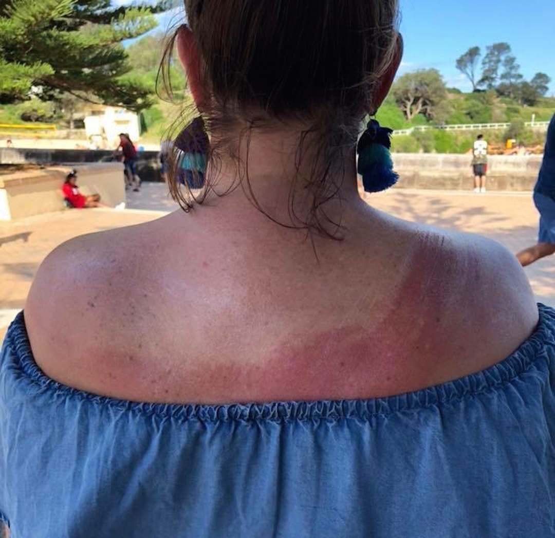 Bad sunscreen effort, Sydney